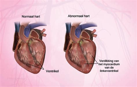 linkse ventrikel vermoeid.